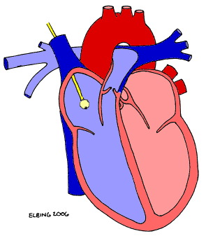 PA insertion